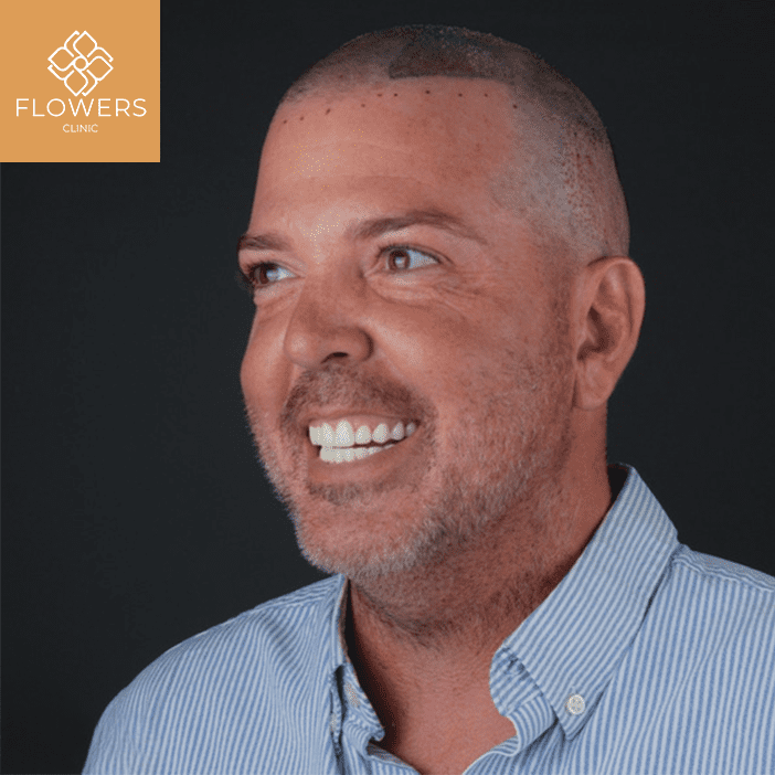 trapianto capelli e barba con tecniche moderne