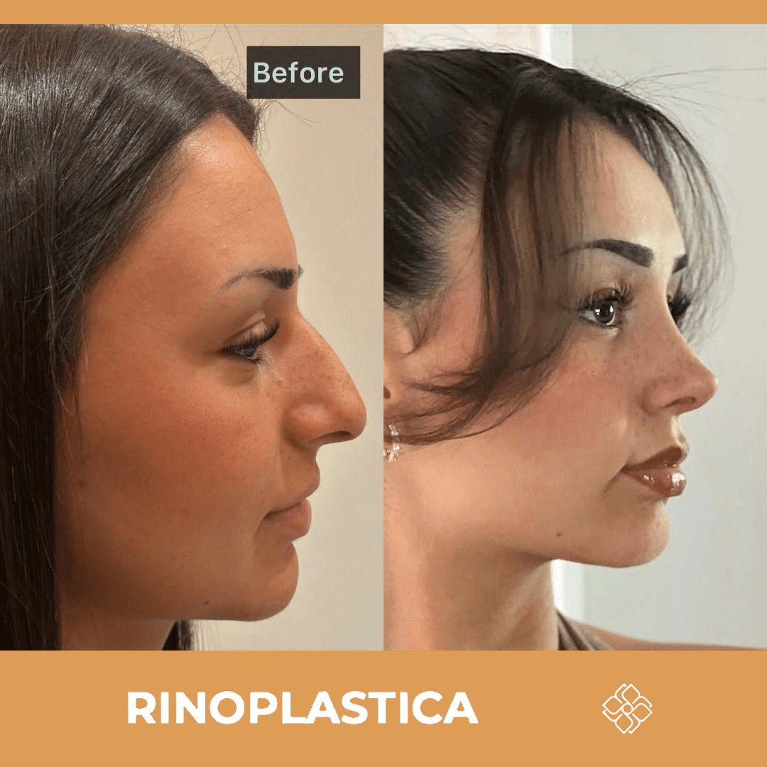 lifting non chirurgico turchia