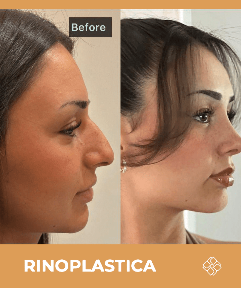 lifting non chirurgico turchia