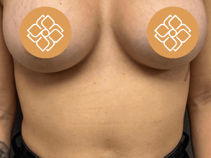 corone estetiche zirconia